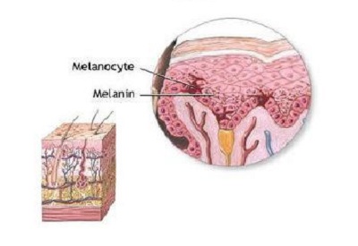 Melanotan II effects