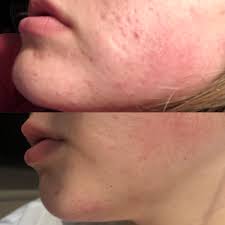 What is Azelaic acid?